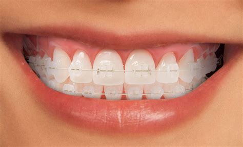 diferencia entre brackets de porcelana y metalicos|Brackets de cerámica .